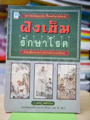 ฝังเข็มรักษาโรค รูปที่ 1