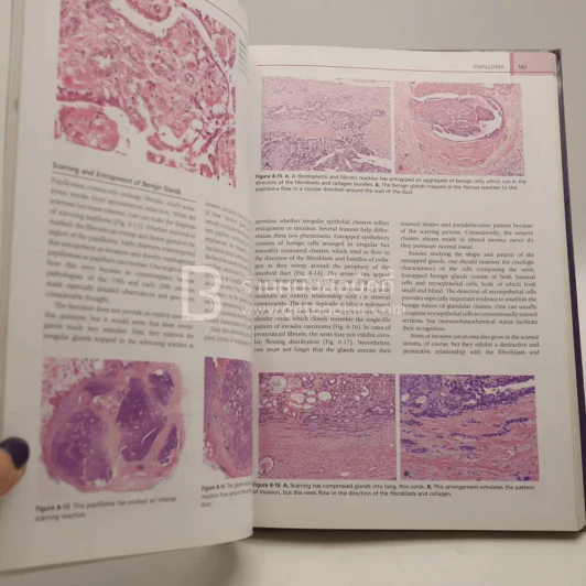 Diagnostic Problems in Breast Pathology รูปที่ 4