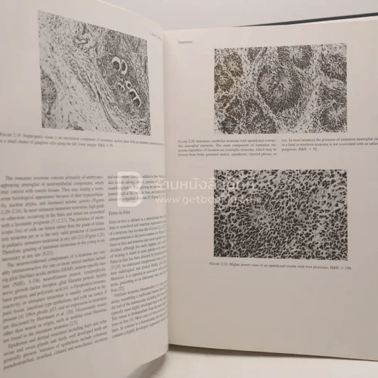 Tumors of the Fetus and Infant - An Atlas รูปที่ 4