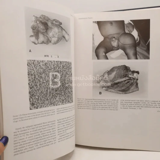 Tumors of the Fetus and Infant - An Atlas รูปที่ 5