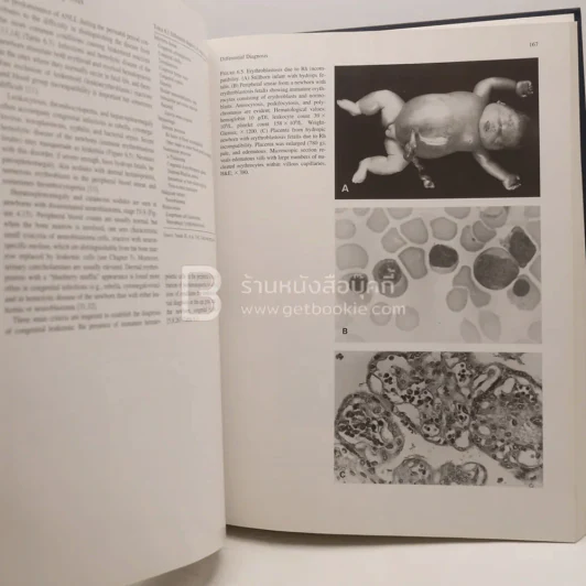 Tumors of the Fetus and Infant - An Atlas รูปที่ 6