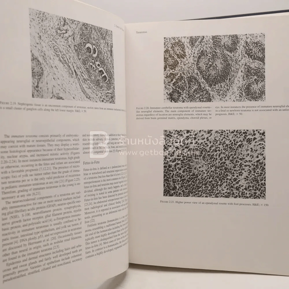 Tumors of the Fetus and Infant - An Atlas รูปที่ 4