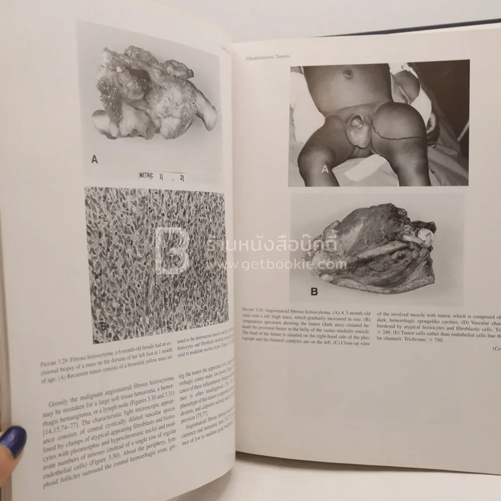 Tumors of the Fetus and Infant - An Atlas รูปที่ 5