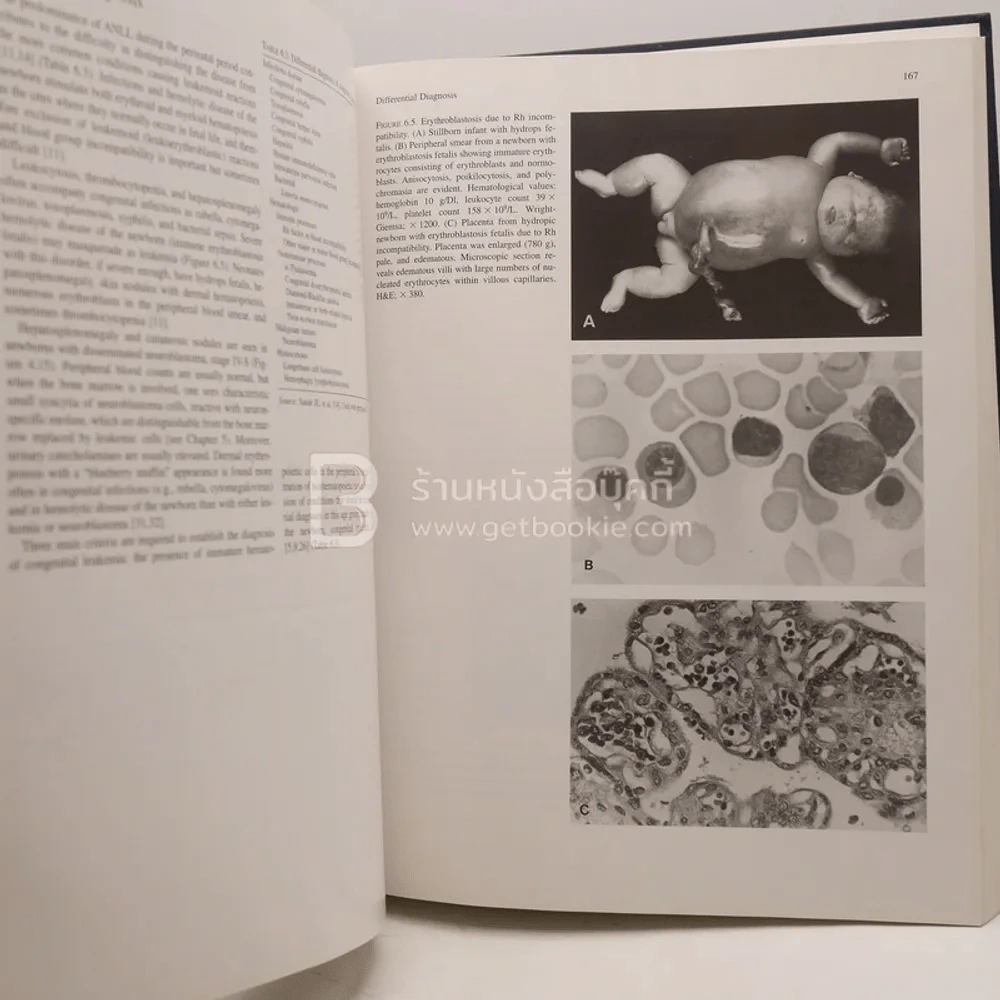 Tumors of the Fetus and Infant - An Atlas รูปที่ 6