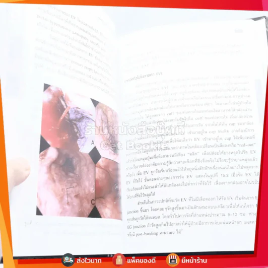 เลือดออกในทางเดินอาหาร Gastrointestinal Bleeding รูปที่ 3