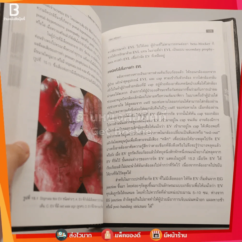 เลือดออกในทางเดินอาหาร Gastrointestinal Bleeding รูปที่ 4