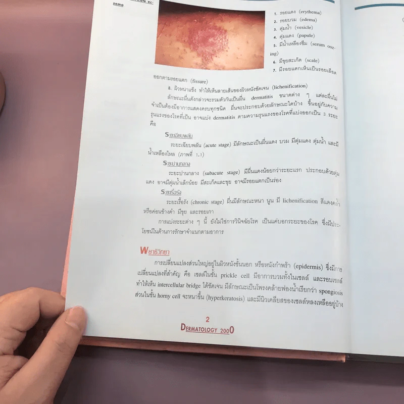 Dermatology 2000 ตำราโรคผิวหนังในเวชปฏิบัติปัจจุบัน รูปที่ 24