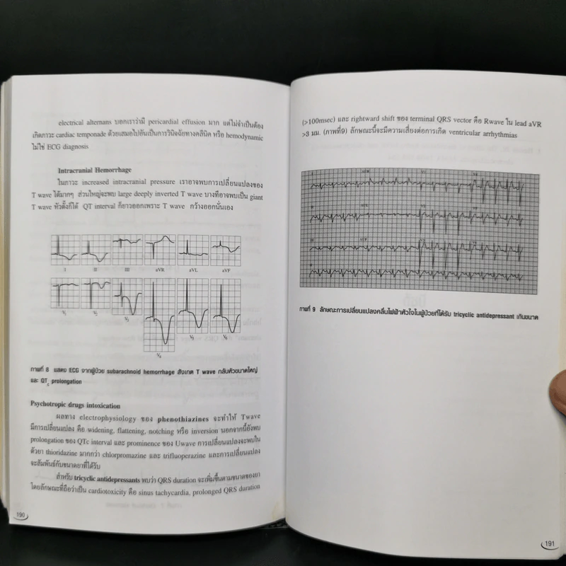Electrocardiography for medical student sixth edition - อภิชาต สุคนธสรรพ์ รูปที่ 14