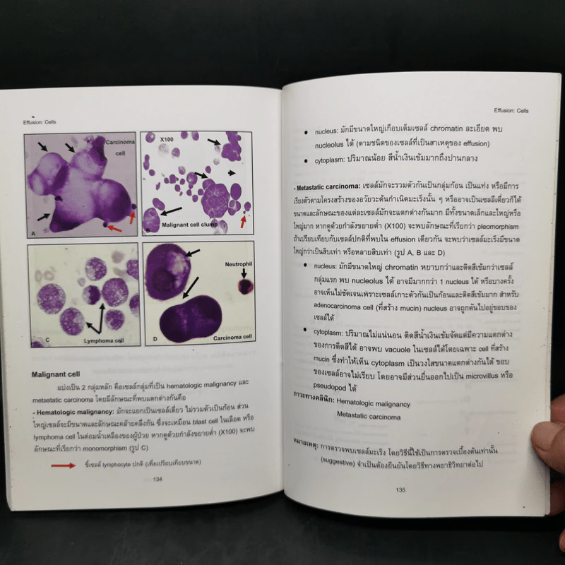 Atlas of Hematology and Body Fluides ภาควิชาพยาธิวิทยาคลินิก รูปที่ 12