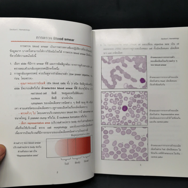 Atlas of Hematology and Body Fluides ภาควิชาพยาธิวิทยาคลินิก รูปที่ 11