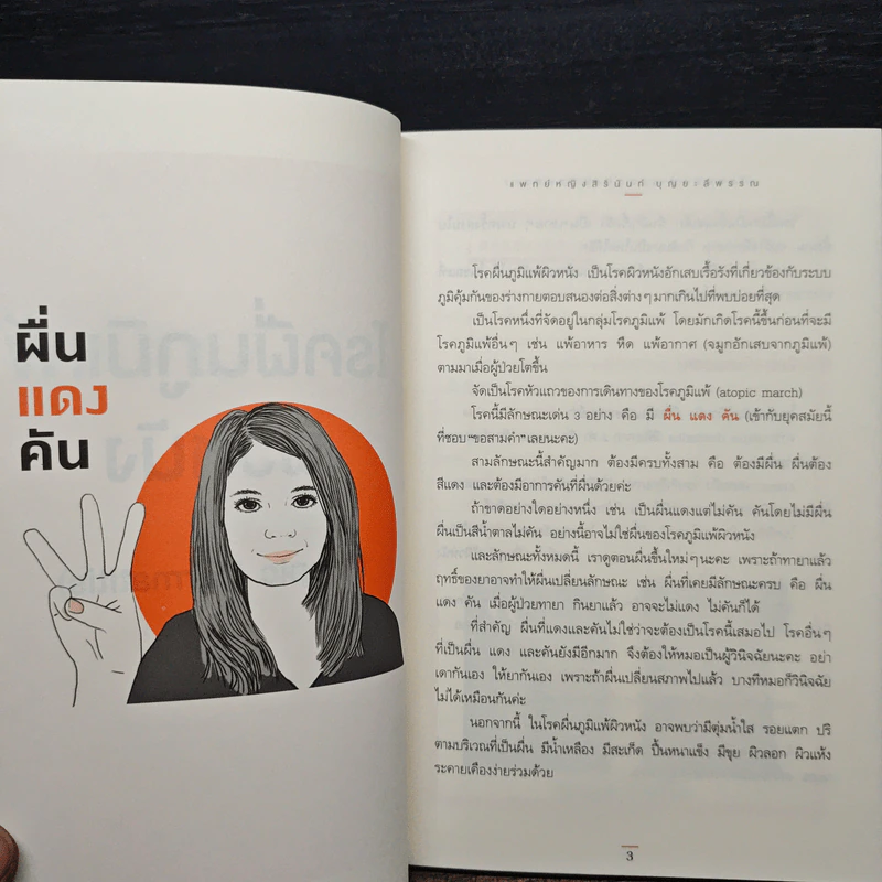 โรคภูมิแพ้ ตอน ภูมิแพ้ผิวหนัง - แพทย์หญิงสิรินันท์ บุญยะลีพรรณ รูปที่ 8