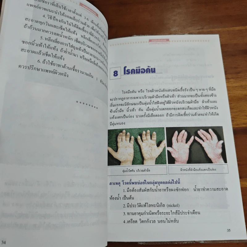 รอบรู้เรื่องโรคผิวหนัง - นพ.สมบูรณ์ จิรโรจน์วัฒน รูปที่ 8