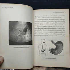 นิ่วในถุงน้ำดี - รองศาสตราจารย์นายแพทย์พัฒน์พงศ์ นาวีเจริญ รูปที่ 9