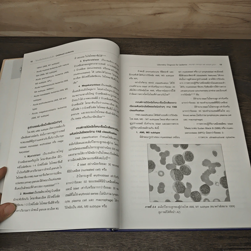 โรคมะเร็งเม็ดเลือดขาวในเด็ก Childhood Leukemia - สามารถ ภคกษมา รูปที่ 7