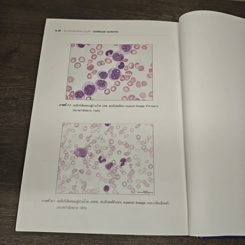 โรคมะเร็งเม็ดเลือดขาวในเด็ก Childhood Leukemia - สามารถ ภคกษมา รูปที่ 8