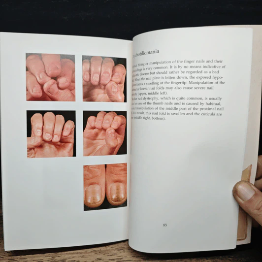 Nails: A Manual and Atlas - Kristian Thomsen รูปที่ 9
