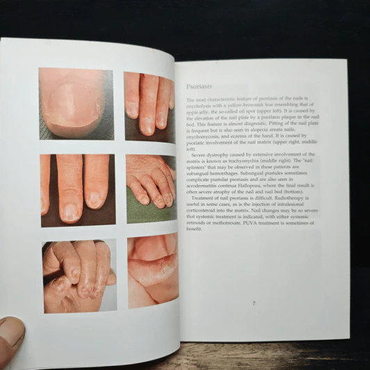 Nails: A Manual and Atlas - Kristian Thomsen รูปที่ 8