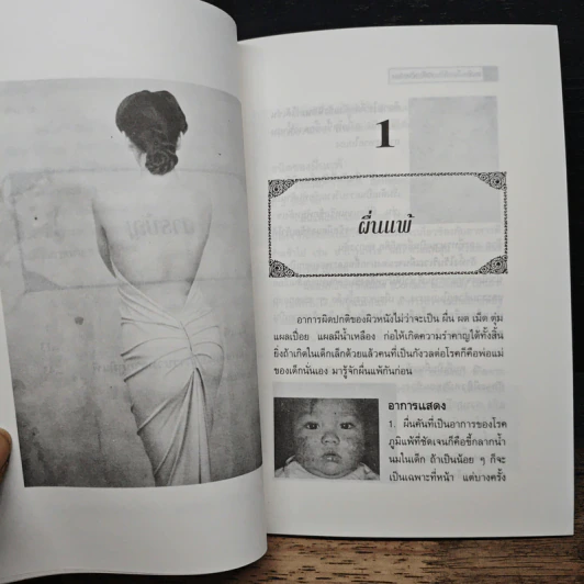 ลมพิษ-ผื่นแพ้กับการรักษาตนเอง - นพ.ไพบูลย์ จาตุรปัญญา รูปที่ 8