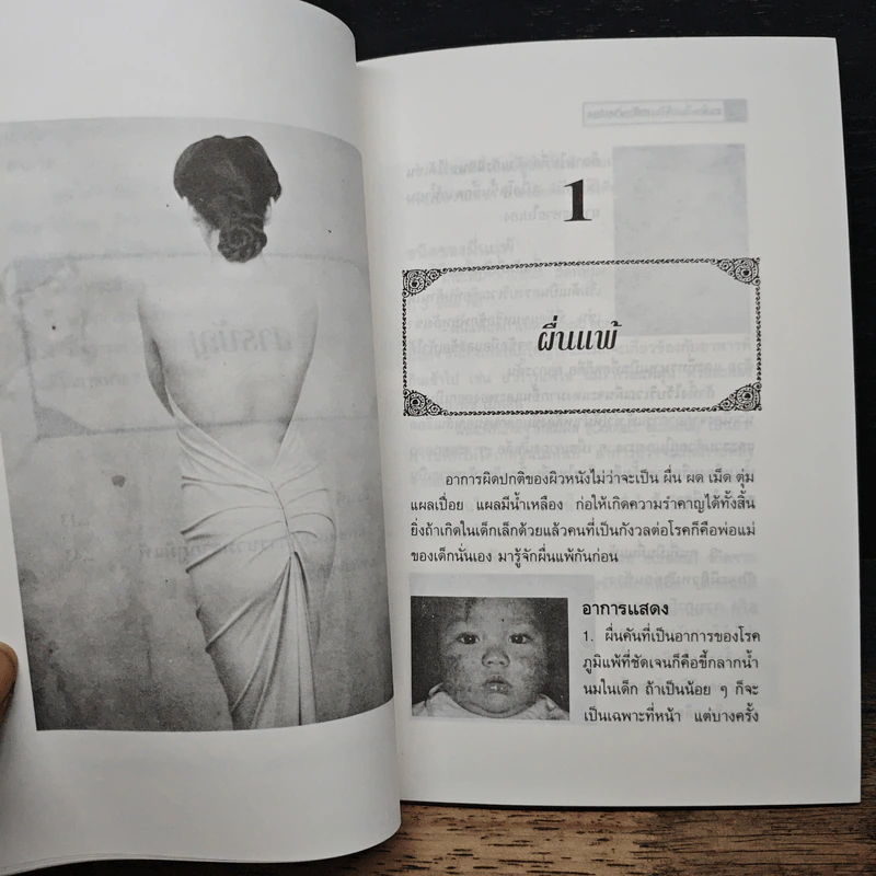 ลมพิษ-ผื่นแพ้กับการรักษาตนเอง - นพ.ไพบูลย์ จาตุรปัญญา รูปที่ 8