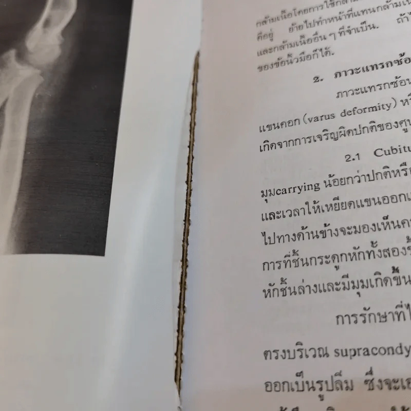 ภยันตรายที่กระดูกและข้อในเด็ก - เจริญ โชติกวณิชย์ รูปที่ 28