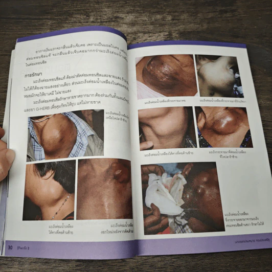 รู้ทันมะเร็ง 2 ฉบับสมบูรณ์ - อัศวิน ทองประเสริฐ รูปที่ 8