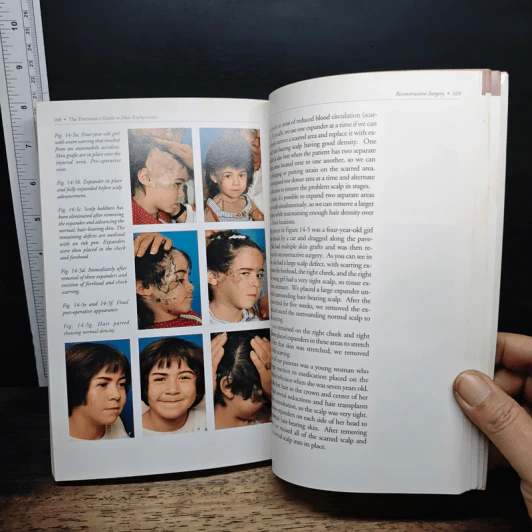 The Everyman's Guide to Hair Replacement รูปที่ 9