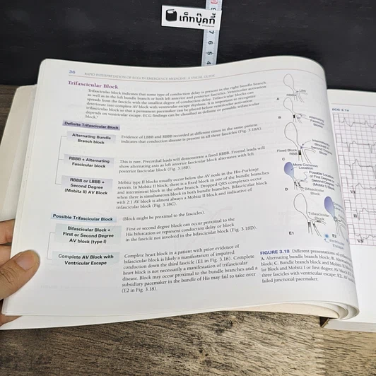 หนังสือ Rapid Interpretation of ECGs in Emergency Medicine รูปที่ 8